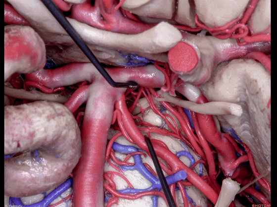 外展枕怎么使用脑干解剖及相关入路---Rhoton解剖视频学习笔记系列_https://www.jmylbn.com_新闻资讯_第43张