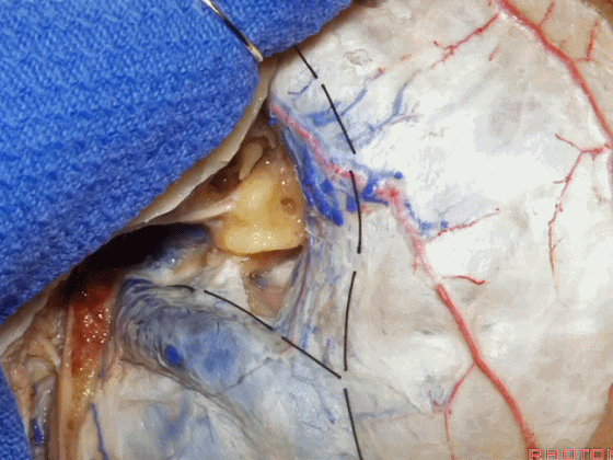 外展枕怎么使用脑干解剖及相关入路---Rhoton解剖视频学习笔记系列_https://www.jmylbn.com_新闻资讯_第295张