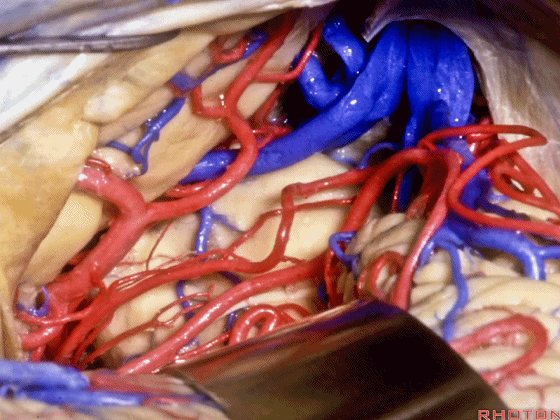 外展枕怎么使用脑干解剖及相关入路---Rhoton解剖视频学习笔记系列_https://www.jmylbn.com_新闻资讯_第219张