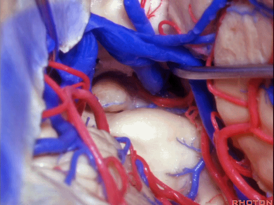 外展枕怎么使用脑干解剖及相关入路---Rhoton解剖视频学习笔记系列_https://www.jmylbn.com_新闻资讯_第228张