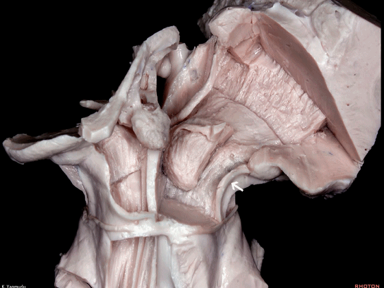 外展枕怎么使用脑干解剖及相关入路---Rhoton解剖视频学习笔记系列_https://www.jmylbn.com_新闻资讯_第90张