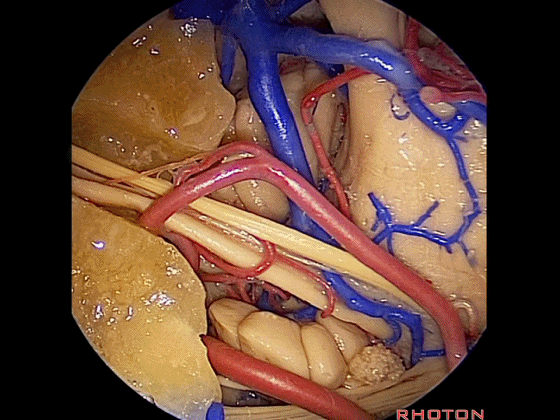 外展枕怎么使用脑干解剖及相关入路---Rhoton解剖视频学习笔记系列_https://www.jmylbn.com_新闻资讯_第365张
