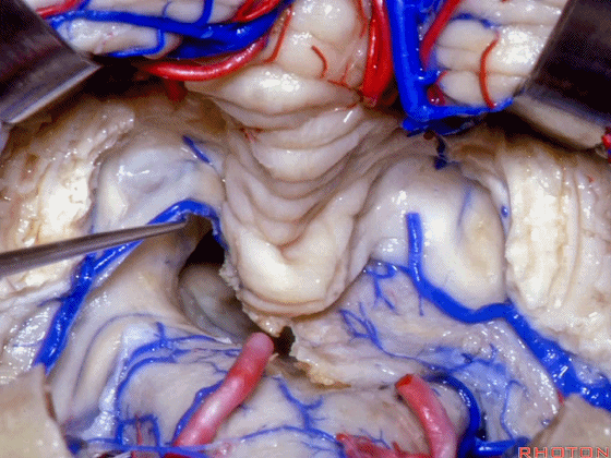 外展枕怎么使用脑干解剖及相关入路---Rhoton解剖视频学习笔记系列_https://www.jmylbn.com_新闻资讯_第262张