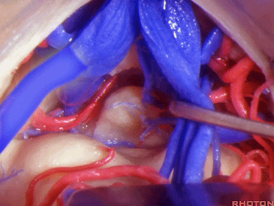 外展枕怎么使用脑干解剖及相关入路---Rhoton解剖视频学习笔记系列_https://www.jmylbn.com_新闻资讯_第216张