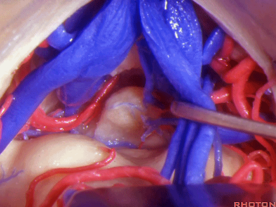 外展枕怎么使用脑干解剖及相关入路---Rhoton解剖视频学习笔记系列_https://www.jmylbn.com_新闻资讯_第214张