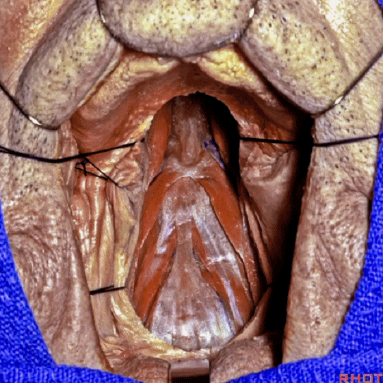 外展枕怎么使用脑干解剖及相关入路---Rhoton解剖视频学习笔记系列_https://www.jmylbn.com_新闻资讯_第310张