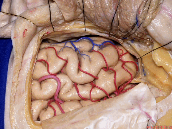 外展枕怎么使用脑干解剖及相关入路---Rhoton解剖视频学习笔记系列_https://www.jmylbn.com_新闻资讯_第171张