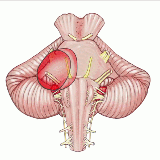 外展枕怎么使用脑干解剖及相关入路---Rhoton解剖视频学习笔记系列_https://www.jmylbn.com_新闻资讯_第152张