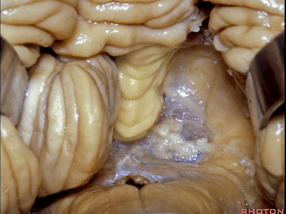 外展枕怎么使用脑干解剖及相关入路---Rhoton解剖视频学习笔记系列_https://www.jmylbn.com_新闻资讯_第234张