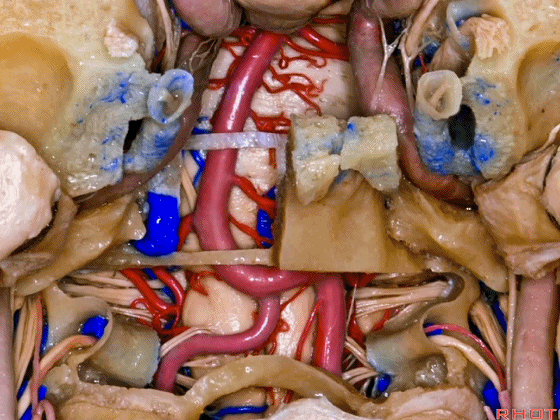 外展枕怎么使用脑干解剖及相关入路---Rhoton解剖视频学习笔记系列_https://www.jmylbn.com_新闻资讯_第354张