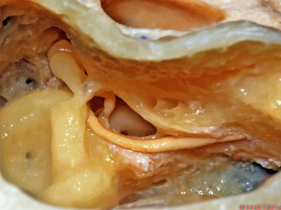 外展枕怎么使用脑干解剖及相关入路---Rhoton解剖视频学习笔记系列_https://www.jmylbn.com_新闻资讯_第280张