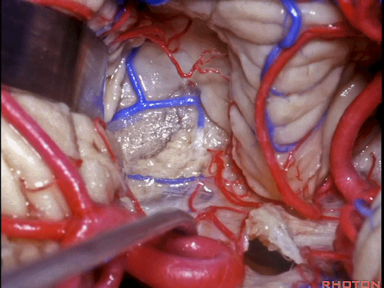 外展枕怎么使用脑干解剖及相关入路---Rhoton解剖视频学习笔记系列_https://www.jmylbn.com_新闻资讯_第245张