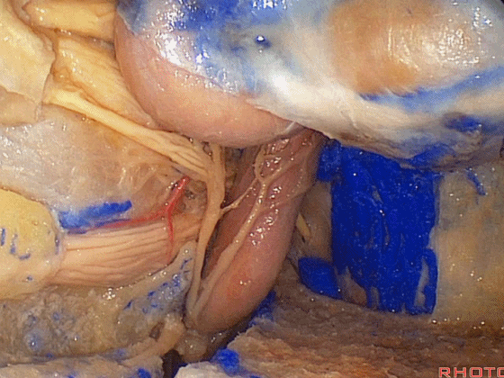 外展枕怎么使用脑干解剖及相关入路---Rhoton解剖视频学习笔记系列_https://www.jmylbn.com_新闻资讯_第346张