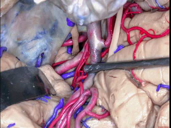 外展枕怎么使用脑干解剖及相关入路---Rhoton解剖视频学习笔记系列_https://www.jmylbn.com_新闻资讯_第46张