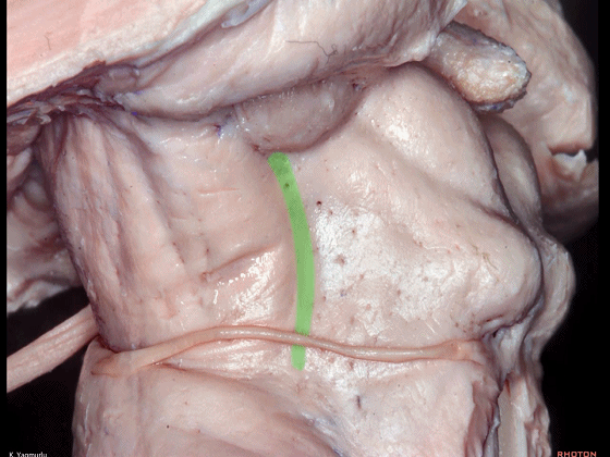 外展枕怎么使用脑干解剖及相关入路---Rhoton解剖视频学习笔记系列_https://www.jmylbn.com_新闻资讯_第63张