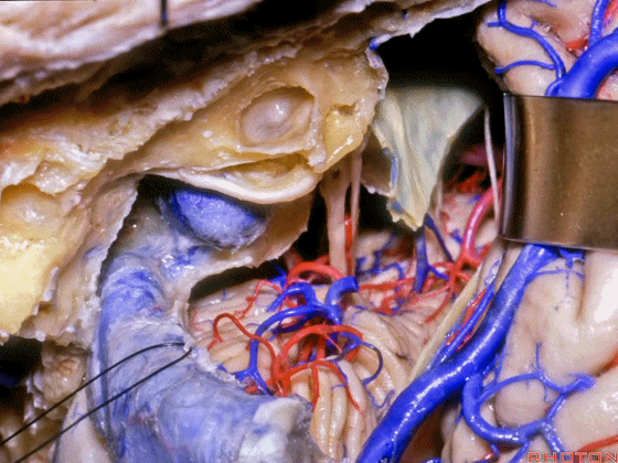 外展枕怎么使用脑干解剖及相关入路---Rhoton解剖视频学习笔记系列_https://www.jmylbn.com_新闻资讯_第298张