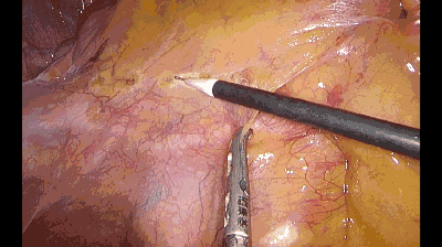 外科拉勾怎么拉腹腔镜电钩操作应用技巧_https://www.jmylbn.com_新闻资讯_第8张