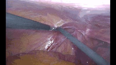 外科拉勾怎么拉腹腔镜电钩操作应用技巧_https://www.jmylbn.com_新闻资讯_第7张