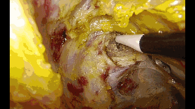 外科拉勾怎么拉腹腔镜电钩操作应用技巧_https://www.jmylbn.com_新闻资讯_第4张