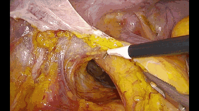 外科拉勾怎么拉腹腔镜电钩操作应用技巧_https://www.jmylbn.com_新闻资讯_第9张