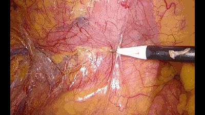 外科拉勾怎么拉腹腔镜电钩操作应用技巧_https://www.jmylbn.com_新闻资讯_第6张