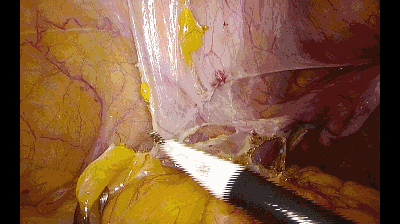 外科拉勾怎么拉腹腔镜电钩操作应用技巧_https://www.jmylbn.com_新闻资讯_第5张