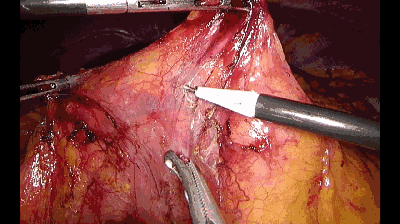 外科拉勾怎么拉腹腔镜电钩操作应用技巧_https://www.jmylbn.com_新闻资讯_第1张