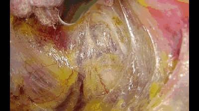 外科拉勾怎么拉腹腔镜电钩操作应用技巧_https://www.jmylbn.com_新闻资讯_第2张