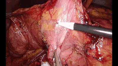 外科拉勾怎么拉腹腔镜电钩操作应用技巧_https://www.jmylbn.com_新闻资讯_第3张