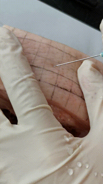 为什么输血不能用小针小时候常打的“屁股针”，为什么现在变少了？_https://www.jmylbn.com_新闻资讯_第8张