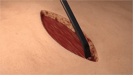 为什么电极能止血集采突围！创新止血电外科耗材，百亿市场，全国招商！_https://www.jmylbn.com_新闻资讯_第8张