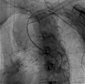 治疗车怎么推【弓部重建直通车】梅州市人民医院心内科团队运用Castor®分支型支架联合预开窗技术治疗主动脉弓动脉瘤合并迷走右锁骨下动_https://www.jmylbn.com_新闻资讯_第13张