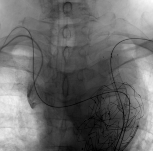 治疗车怎么推【弓部重建直通车】梅州市人民医院心内科团队运用Castor®分支型支架联合预开窗技术治疗主动脉弓动脉瘤合并迷走右锁骨下动_https://www.jmylbn.com_新闻资讯_第15张