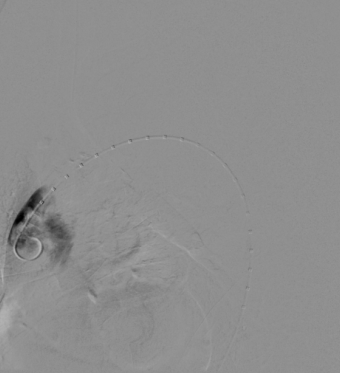 治疗车怎么推【弓部重建直通车】梅州市人民医院心内科团队运用Castor®分支型支架联合预开窗技术治疗主动脉弓动脉瘤合并迷走右锁骨下动_https://www.jmylbn.com_新闻资讯_第6张