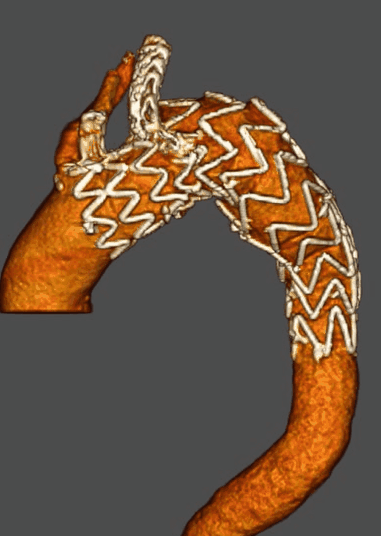 治疗车怎么推【弓部重建直通车】梅州市人民医院心内科团队运用Castor®分支型支架联合预开窗技术治疗主动脉弓动脉瘤合并迷走右锁骨下动_https://www.jmylbn.com_新闻资讯_第19张