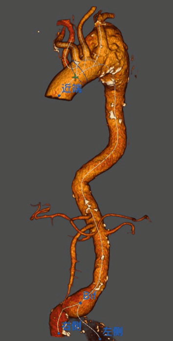 治疗车怎么推【弓部重建直通车】梅州市人民医院心内科团队运用Castor®分支型支架联合预开窗技术治疗主动脉弓动脉瘤合并迷走右锁骨下动_https://www.jmylbn.com_新闻资讯_第3张