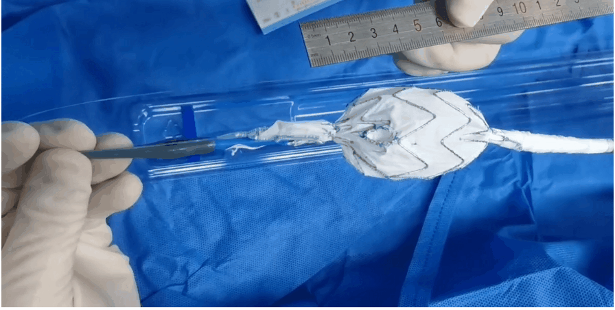 治疗车怎么推【弓部重建直通车】梅州市人民医院心内科团队运用Castor®分支型支架联合预开窗技术治疗主动脉弓动脉瘤合并迷走右锁骨下动_https://www.jmylbn.com_新闻资讯_第9张