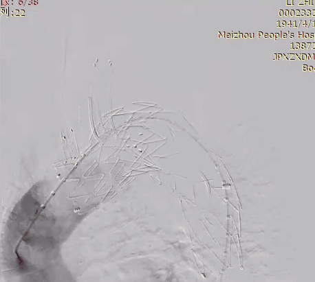 治疗车怎么推【弓部重建直通车】梅州市人民医院心内科团队运用Castor®分支型支架联合预开窗技术治疗主动脉弓动脉瘤合并迷走右锁骨下动_https://www.jmylbn.com_新闻资讯_第18张