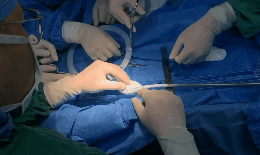 治疗车怎么推【弓部重建直通车】梅州市人民医院心内科团队运用Castor®分支型支架联合预开窗技术治疗主动脉弓动脉瘤合并迷走右锁骨下动_https://www.jmylbn.com_新闻资讯_第8张