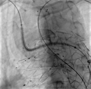 治疗车怎么推【弓部重建直通车】梅州市人民医院心内科团队运用Castor®分支型支架联合预开窗技术治疗主动脉弓动脉瘤合并迷走右锁骨下动_https://www.jmylbn.com_新闻资讯_第16张