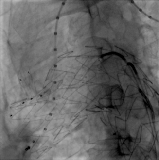 治疗车怎么推【弓部重建直通车】梅州市人民医院心内科团队运用Castor®分支型支架联合预开窗技术治疗主动脉弓动脉瘤合并迷走右锁骨下动_https://www.jmylbn.com_新闻资讯_第12张