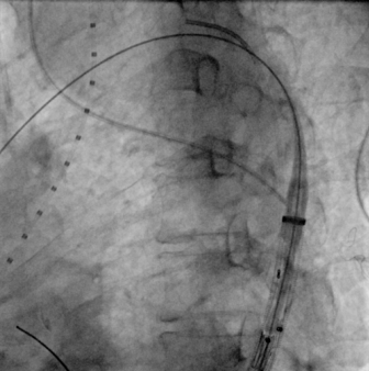 治疗车怎么推【弓部重建直通车】梅州市人民医院心内科团队运用Castor®分支型支架联合预开窗技术治疗主动脉弓动脉瘤合并迷走右锁骨下动_https://www.jmylbn.com_新闻资讯_第10张