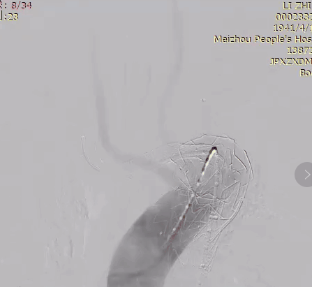 治疗车怎么推【弓部重建直通车】梅州市人民医院心内科团队运用Castor®分支型支架联合预开窗技术治疗主动脉弓动脉瘤合并迷走右锁骨下动_https://www.jmylbn.com_新闻资讯_第17张