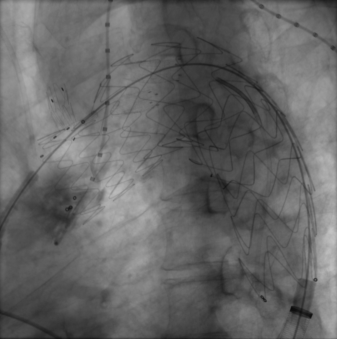 治疗车怎么推【弓部重建直通车】梅州市人民医院心内科团队运用Castor®分支型支架联合预开窗技术治疗主动脉弓动脉瘤合并迷走右锁骨下动_https://www.jmylbn.com_新闻资讯_第11张