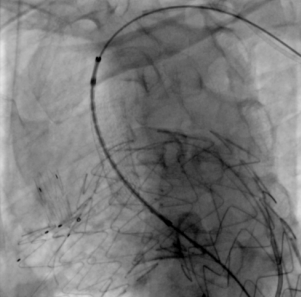 治疗车怎么推【弓部重建直通车】梅州市人民医院心内科团队运用Castor®分支型支架联合预开窗技术治疗主动脉弓动脉瘤合并迷走右锁骨下动_https://www.jmylbn.com_新闻资讯_第14张