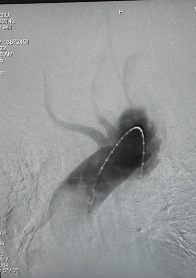 治疗车怎么推【弓部重建直通车】梅州市人民医院心内科团队运用Castor®分支型支架联合预开窗技术治疗主动脉弓动脉瘤合并迷走右锁骨下动_https://www.jmylbn.com_新闻资讯_第5张