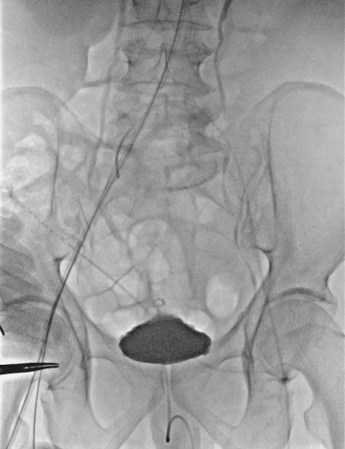 动脉长鞘怎么置入【弓部重建直通车】真腔难觅，另辟蹊径｜潍坊市人民医院血管外科运用Castor®支架结合长鞘建立导丝通路治疗主动脉夹层两例_https://www.jmylbn.com_新闻资讯_第8张