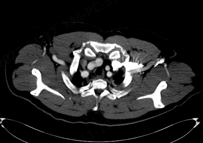 动脉长鞘怎么置入【弓部重建直通车】真腔难觅，另辟蹊径｜潍坊市人民医院血管外科运用Castor®支架结合长鞘建立导丝通路治疗主动脉夹层两例_https://www.jmylbn.com_新闻资讯_第13张