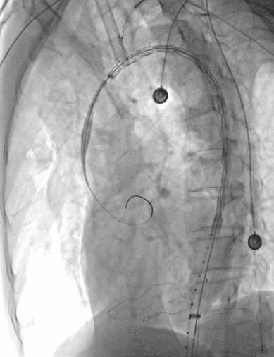 动脉长鞘怎么置入【弓部重建直通车】真腔难觅，另辟蹊径｜潍坊市人民医院血管外科运用Castor®支架结合长鞘建立导丝通路治疗主动脉夹层两例_https://www.jmylbn.com_新闻资讯_第10张