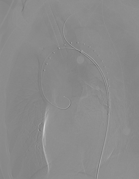 动脉长鞘怎么置入【弓部重建直通车】真腔难觅，另辟蹊径｜潍坊市人民医院血管外科运用Castor®支架结合长鞘建立导丝通路治疗主动脉夹层两例_https://www.jmylbn.com_新闻资讯_第9张